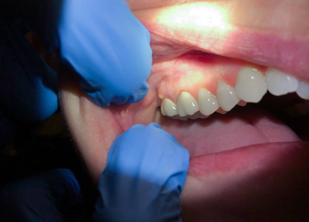 Best Emergency Wisdom Teeth Removal in Wymore, NE