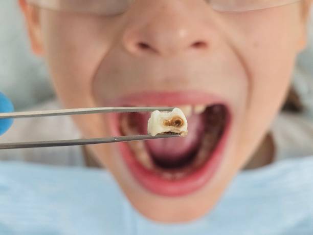 Best Emergency Tooth Extraction in Wymore, NE